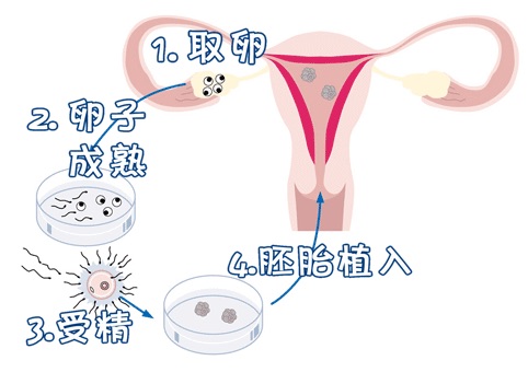试管代怀包生捐卵公司